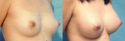 /images/doctors/edween_gallery/photos/breastaug3.jpg