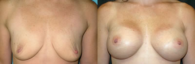 /images/doctors/edween_gallery/photos/breastaug2.jpg